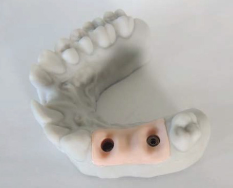 Dental prosthetic